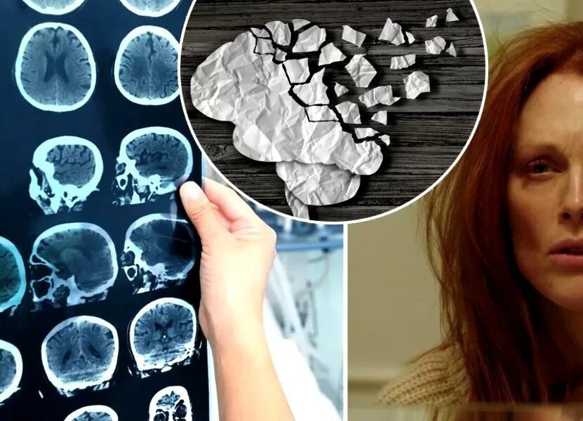 همه چیز درباره آلزایمر، از جمله غیرقابل تصورها!