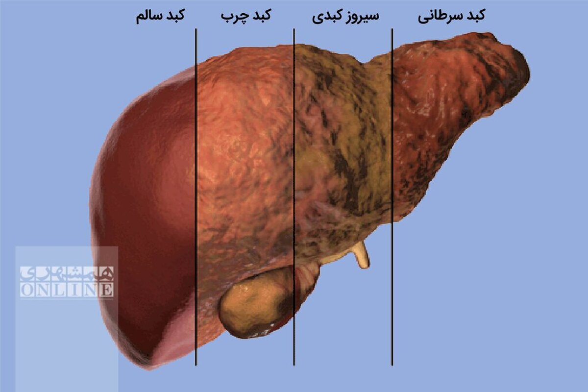 آموزش روش تشخیص فیبروز کبدی؛ دقیق و ساده