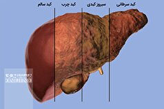آموزش روش تشخیص فیبروز کبدی؛ دقیق و ساده
