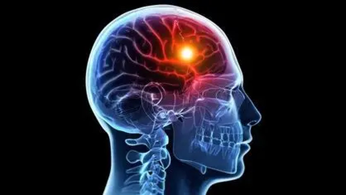 برای مواجهه با سکته مغزی میتوان اقدامی انجام داد؟