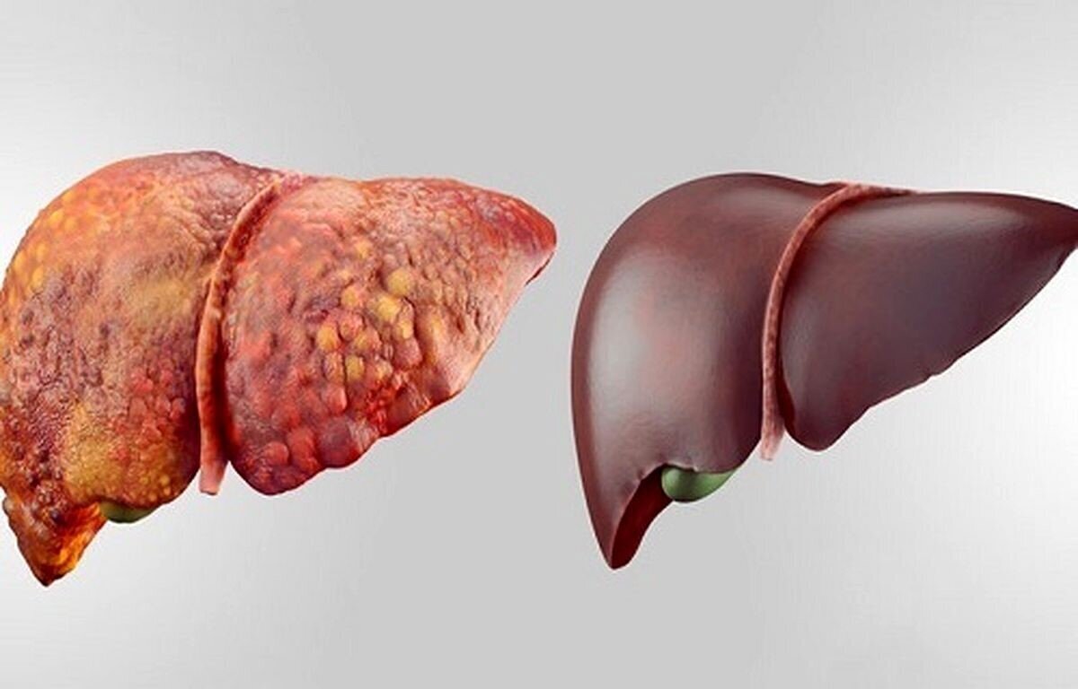 بررسی واقعیت‌های علمی و باور‌های اشتباه درباره پاکسازی کبد