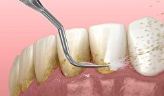 مشکلات پنهان ناشی از جرم گیری دندان