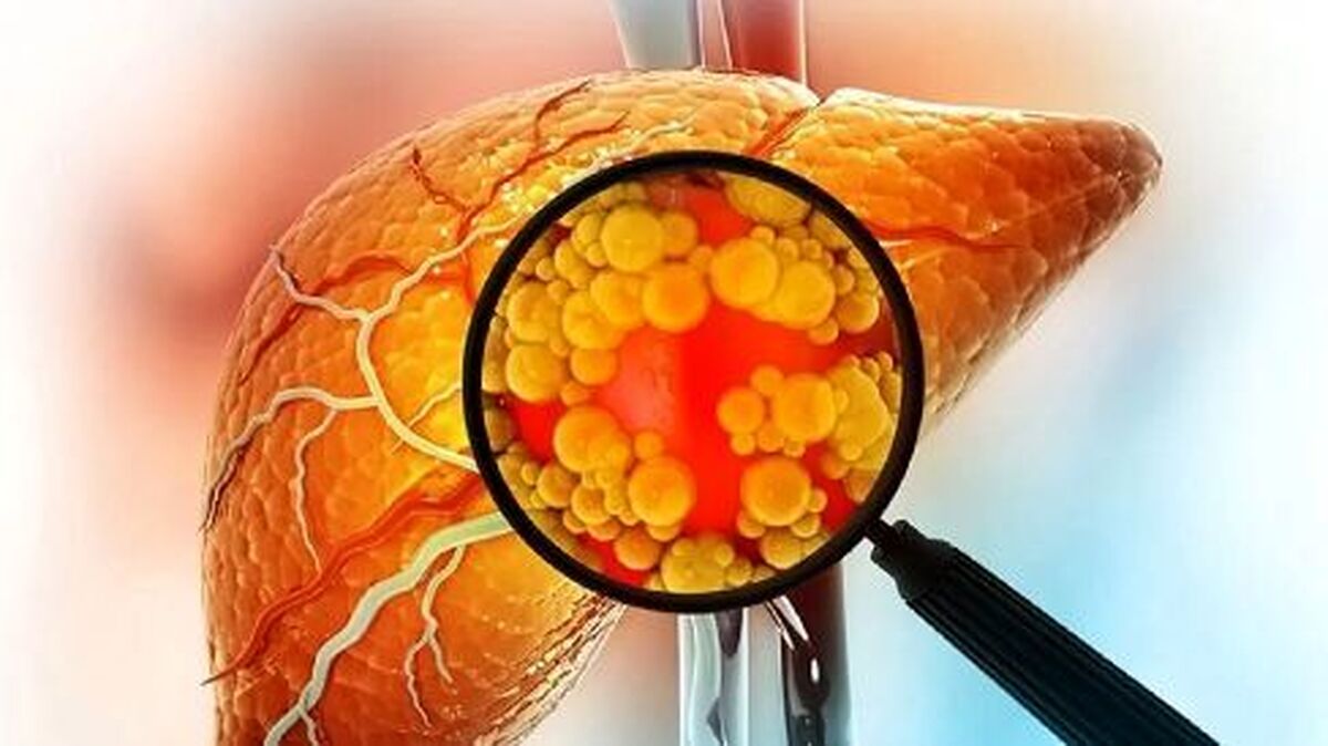 اصلاح سبک زندگی کبد چرب را از شما دور میکند!