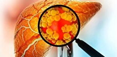 چگونه از ابتلا به کبد چرب پیشگیری کنیم؟ +نشانه‌های اولیه این بیماری