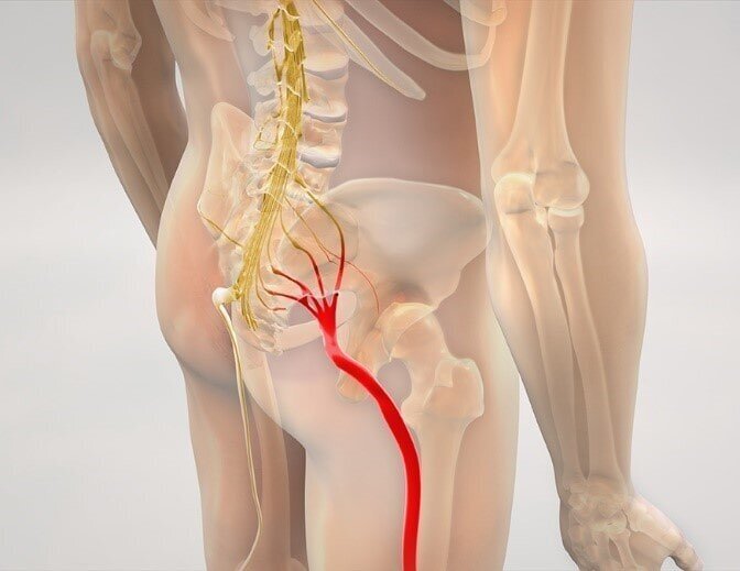 چگونه درد دیسک کمر را از عصب سیاتیک تشخیص دهیم؟