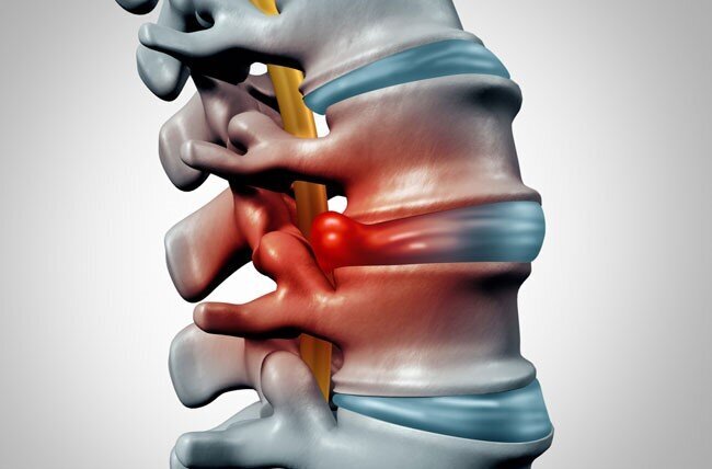 چگونه درد دیسک کمر را از عصب سیاتیک تشخیص دهیم؟