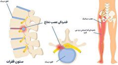 چگونه درد دیسک کمر را از عصب سیاتیک تشخیص دهیم؟