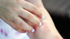 موارد ابتلا به آبله مرغان در روسیه به سرعت در حال افزایش است.