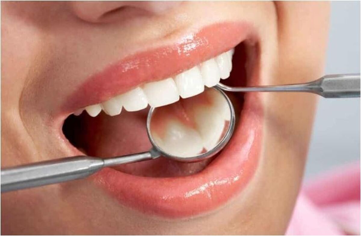 آیا جرم‌گیری دندان مضر است؟ /توصیه یک دندانپزشک