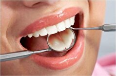 آیا جرم‌گیری دندان مضر است؟ /توصیه یک دندانپزشک