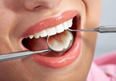 جرم‌گیری دندان آسیب زاست؟