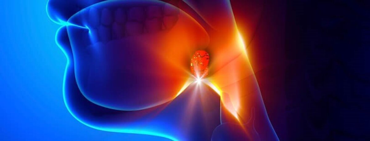 دانستنی‌های مهم درباره علل بوجود آمدن لوزه سوم!