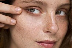 راهنمای کامل مراقبت از لک‌های پوستی و شناخت انواع آنها
