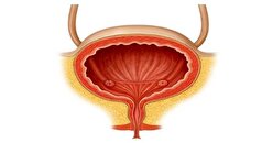 بی‌اختیاری ادرار و سرطان مثانه در پی رعایت نکردن این ۸ نکته
