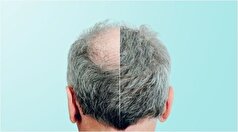 این گیاه معجزه آسا به کمک طاسی سر می‌آید