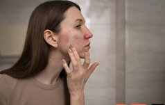 بازیابی سلامت پوست و رفع آکنه با روتین پیشنهادی یک متخصص
