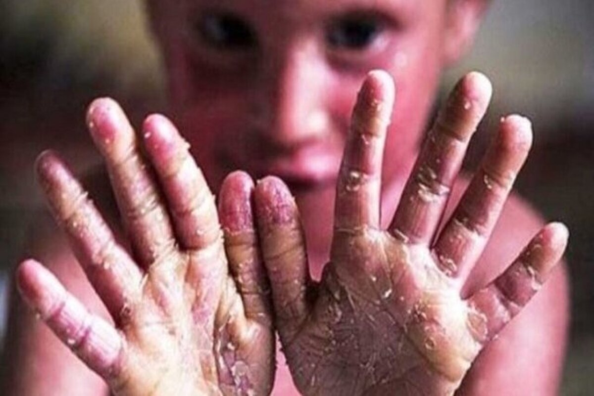 درخواست «خانه‌ای‌بی» از بنیاد بیماری‌های خاص: فهرست خدمات قابل ارایه به بیماران‌ای‌بی را اعلام کنید