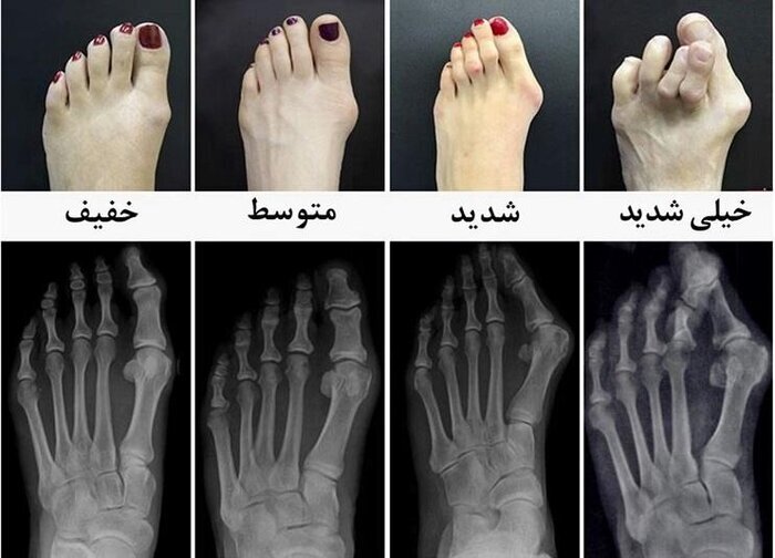 علت بوجود آمدن و روش اصلاح انگشت چکشی پا