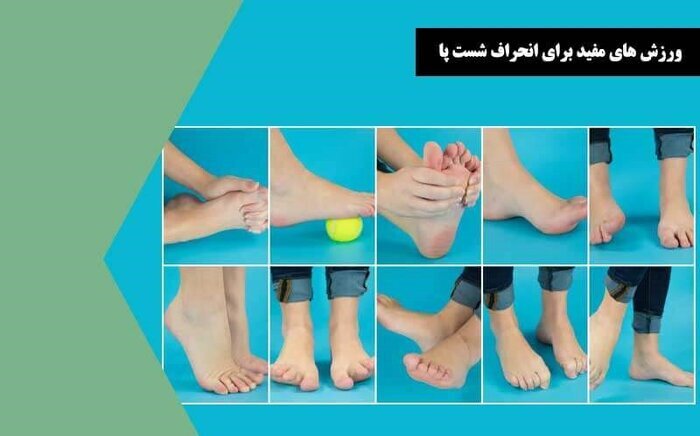 علت بوجود آمدن و روش اصلاح انگشت چکشی پا