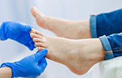 علت بوجود آمدن و روش اصلاح انگشت چکشی پا