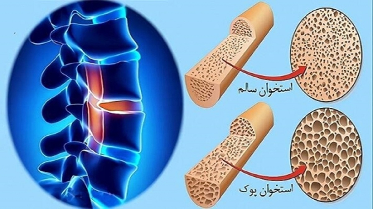 فرآیند کاهش تراکم استخوان از چه تایمی آغار میشود؟