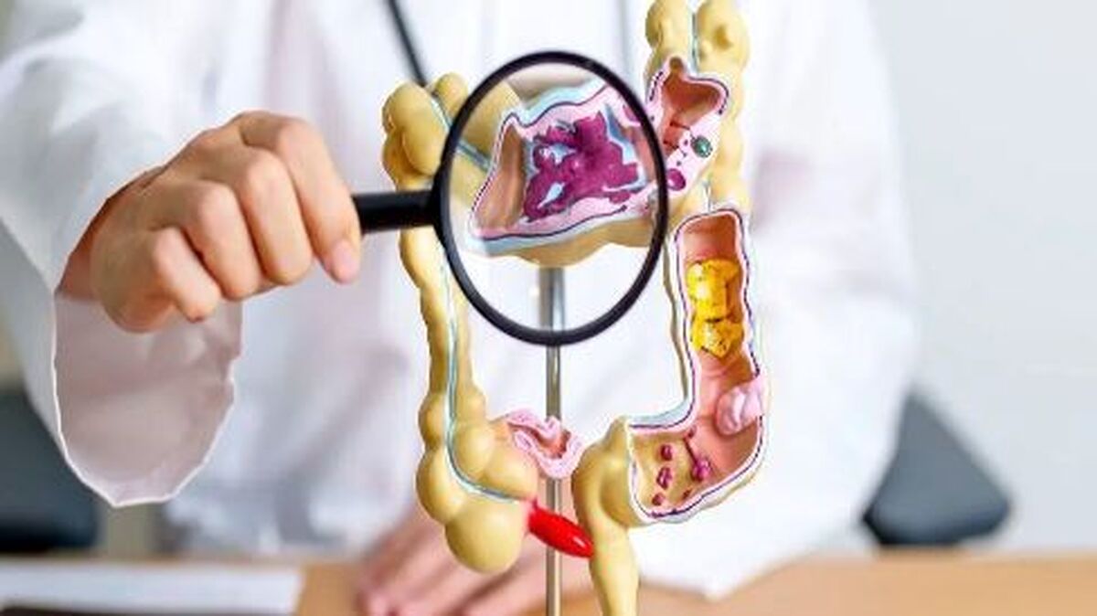 کولونوسکوپی جای خود را به این آزمایش ساده میدهد!