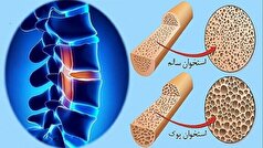 فرآیند کاهش تراکم استخوان از چه تایمی آغار میشود؟