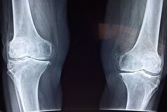 وراثت چه نقشی در ابتلا به پوکی استخوان دارد؟