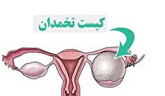 کیست تخمدان؛ مشکل شایع، اما اغلب بی‌خطر در زنان