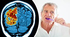 باکتری‌هایی که موجب بیماری لثه می‌شوند، مغز را هدف میگیرند!
