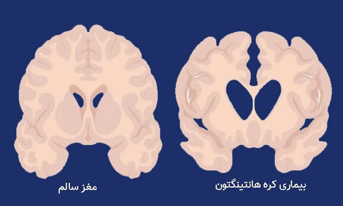 بیماری هانتینگتون برای اولین بار درمانش را پیدا کرد!