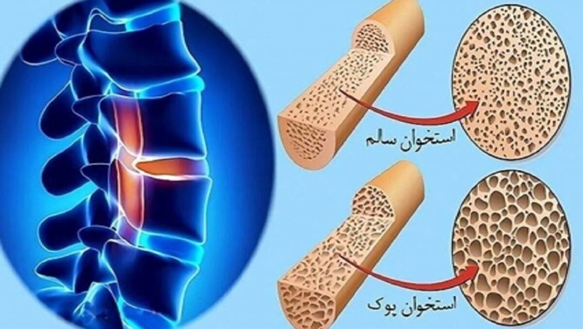 زنان و مردان از چه سنی به پوکی استخوان مبتلا می‌شوند؟