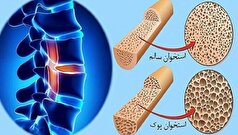 زنان و مردان از چه سنی به پوکی استخوان مبتلا می‌شوند؟