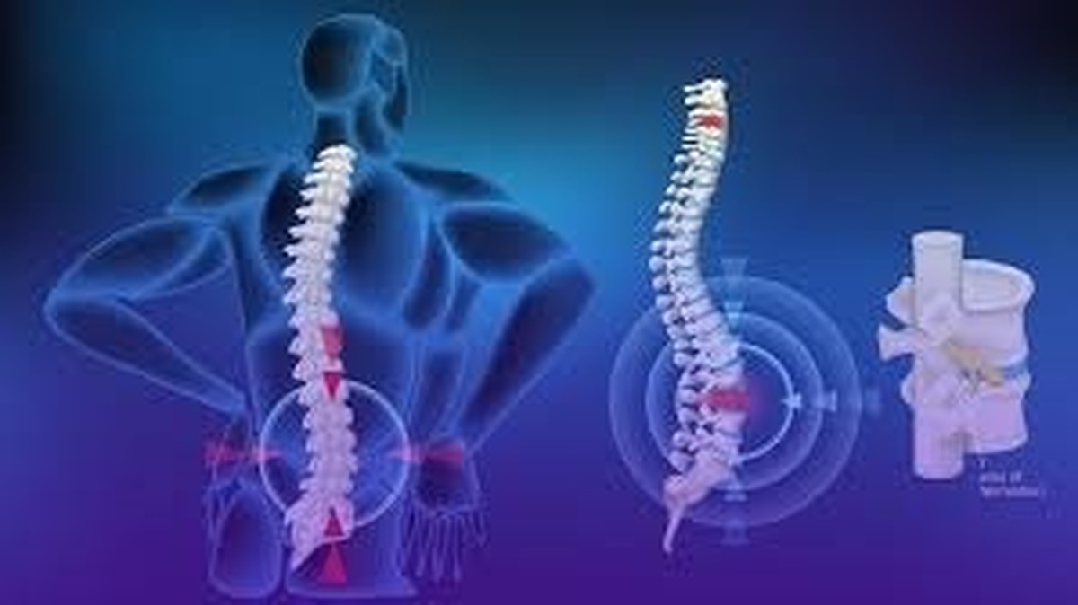 چگونه مانع بروز دیسک کمر شویم؟