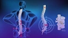 چگونه مانع بروز دیسک کمر شویم؟