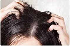 کف سر چرب و ساقه موی خشک/برای حل این مشکل چه باید کرد؟