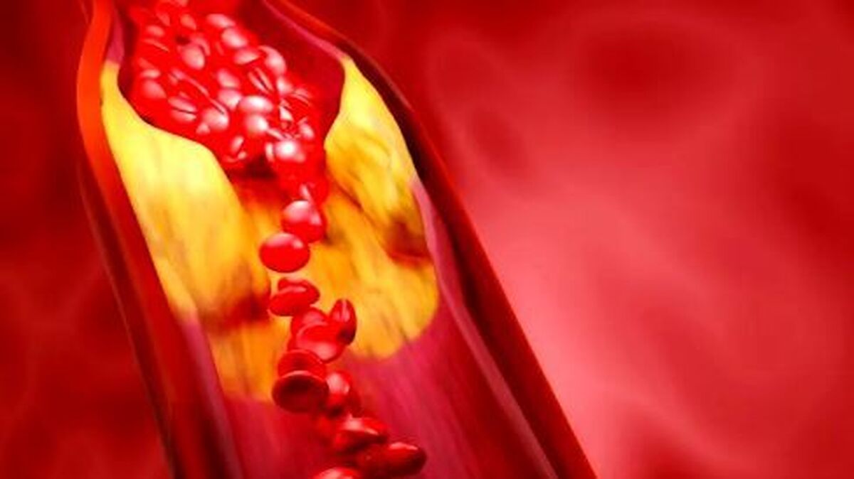 آشنایی با تاثیرات کلسترول و تری‌گلیسیرید بر سلامتی بدن!