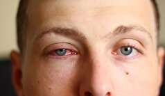 علائم رایج آلرژی چشمی!