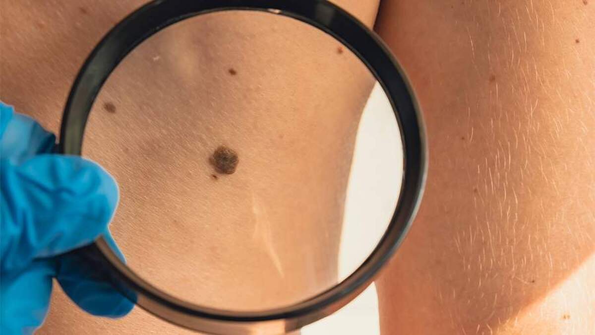 یک متخصص آنکولوژی علل ابتلا به بیماری‌های پوستی را توضیح داد.