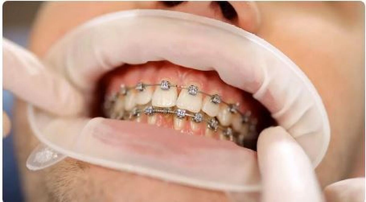 بهترین زمان انجام ارتودنسی در چه سنی است؟