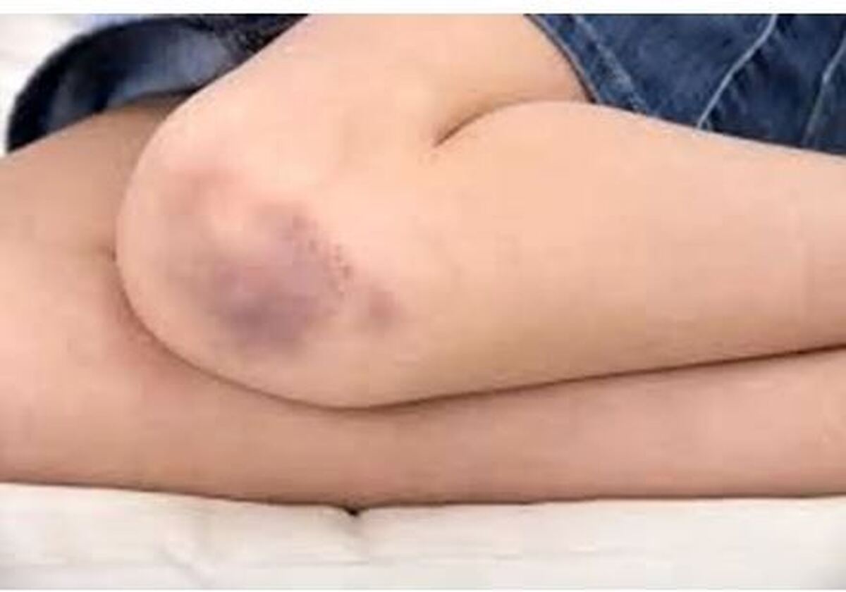 بی توجهی به خونریزی مفصلی ممکن است به فلج اندام منجر شود!