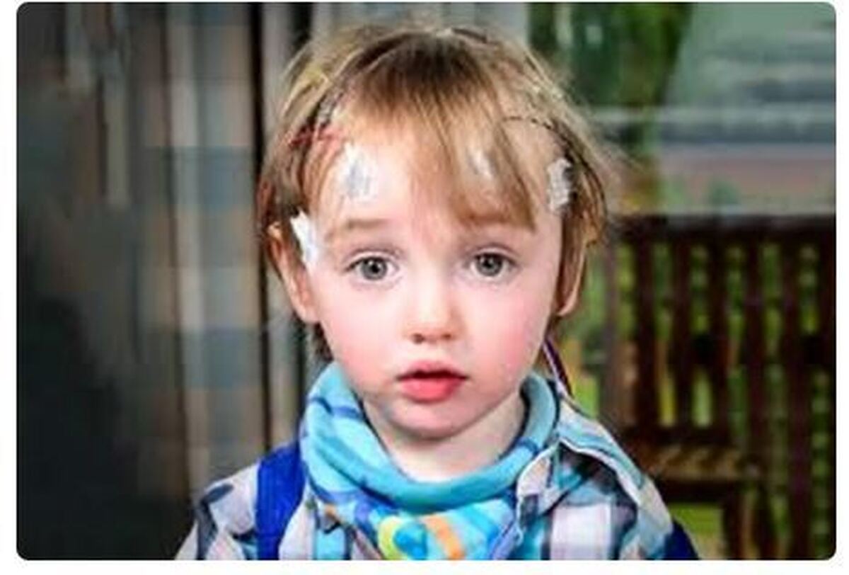 شایعترین علائم صرع در کودکان کدامند؟