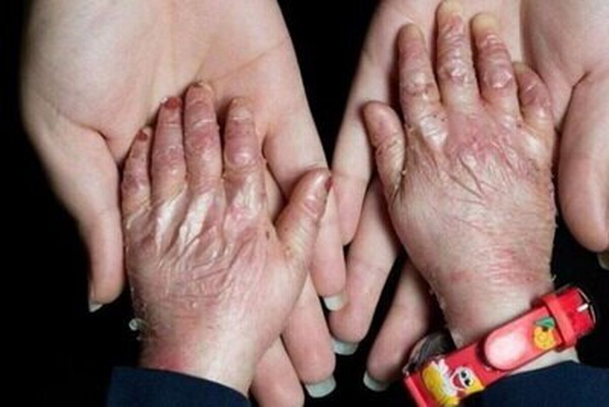 پانسمان حیاتی بیماران پروانه‌ای در فهرست تحریم‌هاست / هیچ کودک پروانه‌ای نباید از تحصیل بازبماند