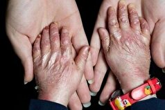 پانسمان حیاتی بیماران پروانه‌ای در فهرست تحریم‌هاست / هیچ کودک پروانه‌ای نباید از تحصیل بازبماند