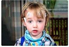 شایع‌ترین علائم صرع در کودکان کدامند؟