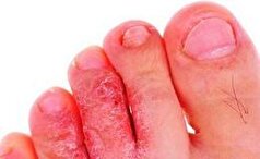 چند تکنیک و راهکار خانگی برای درمان فوری عفونت پای ورزشکاران