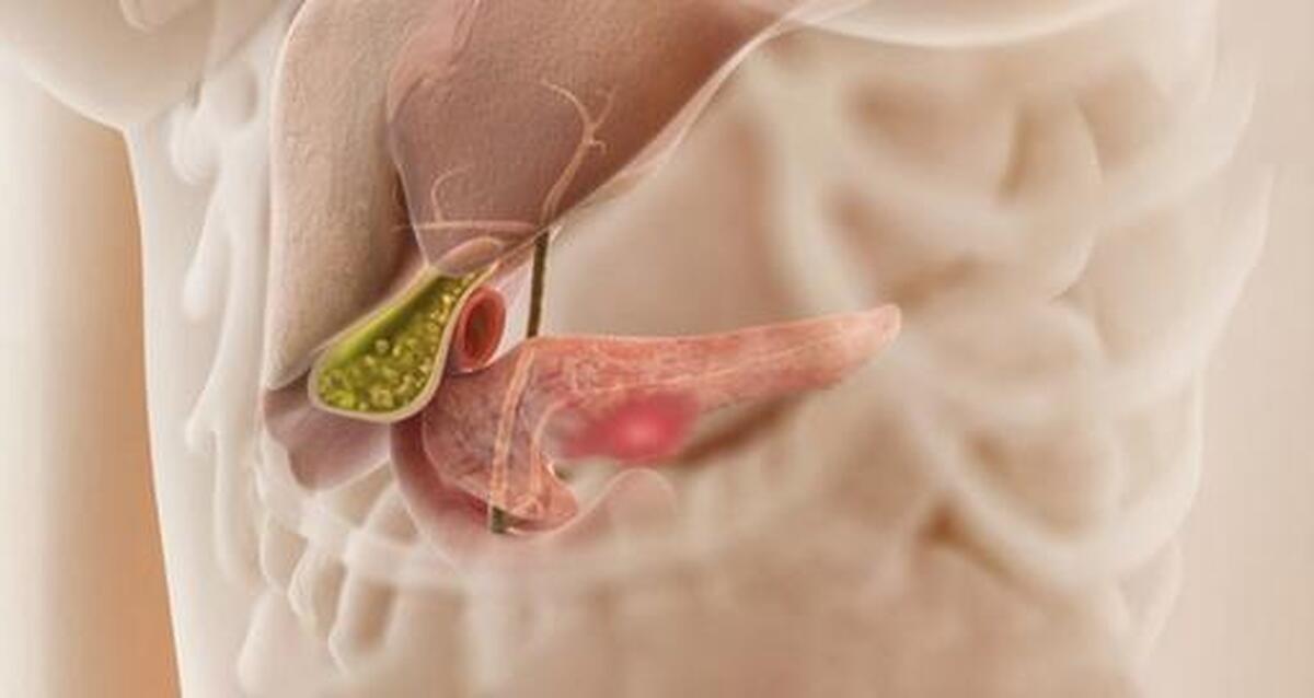 سطح بالای انسولین ارتباط مستقیمی با سرطان پانکراس دارد