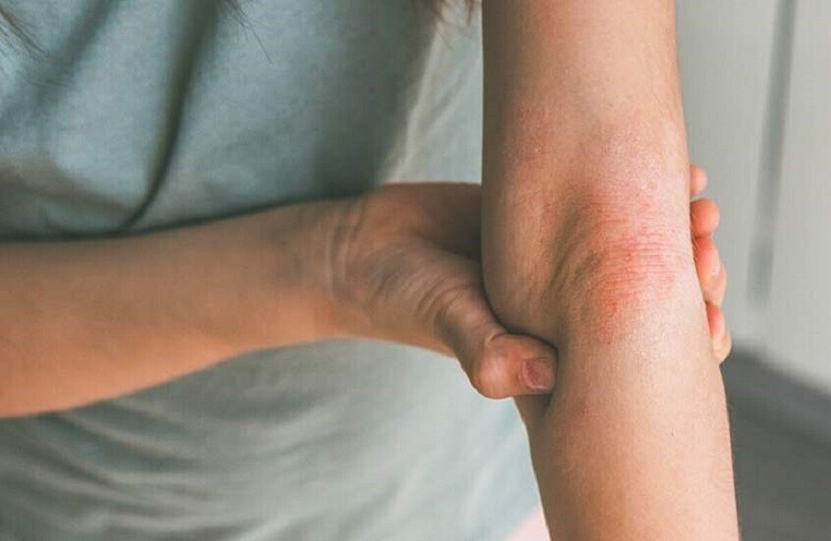 هر آنچه که باید در مورد درماتیت سبورئیک و بهترین راه‌های پیشگیری از آن بدانید