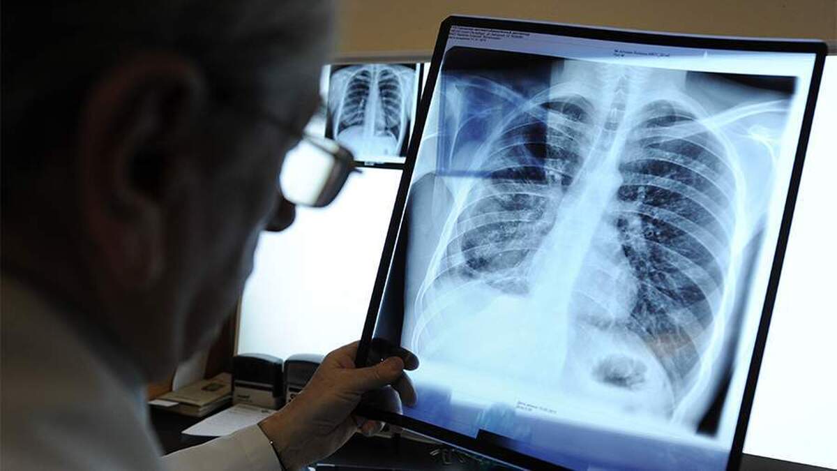 یک پزشک علائم اولیه‌ای را که سل را از سرفه معمولی متمایز می‌کند، توضیح داد.