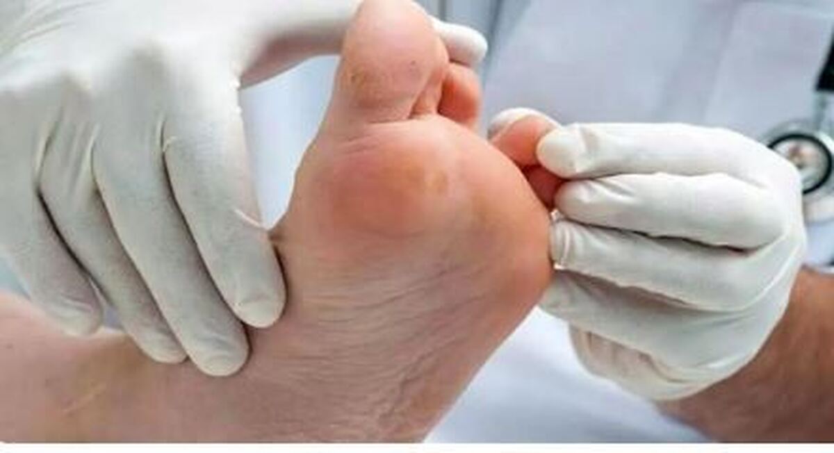 آیا راهی برای زخم پای دیابتی وجود دارد؟